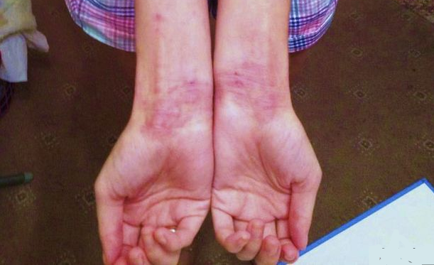 Se reían de ella y la llamaban 'piel de serpiente': Hoy es reina de belleza