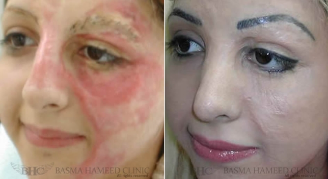 Ella se quemó el rostro con aceite hirviendo y lo corrigió de una forma muy peculiar