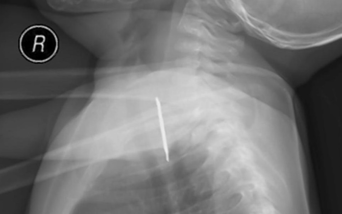 El insólito juguete que los médicos encontraron dentro del esófago de niño saudí