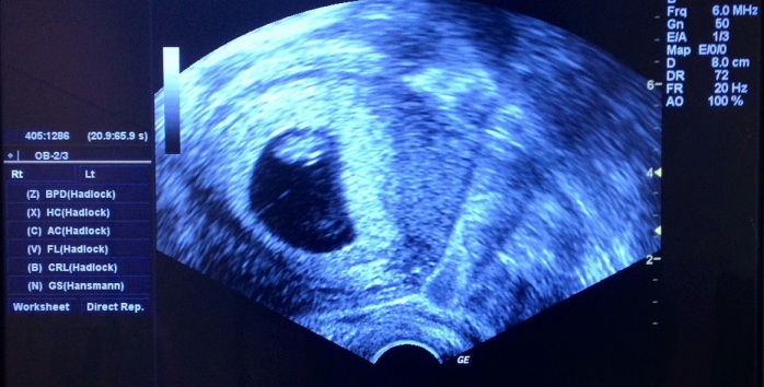 Insólito caso médico: Bebé china nació con dos fetos dentro de su vientre