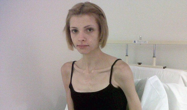 El impactante antes y después de inglesa que llegó a pesar 22 kilos por la anorexia