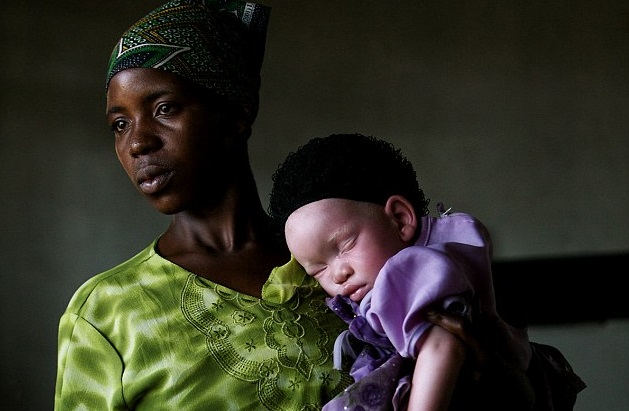 El perturbador motivo por el que le amputaron las manos a tres niños en Tanzania