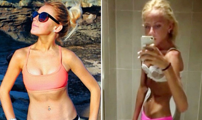 La impactante transformación de joven australiana: Llegó a pesar 30 kilos por la anorexia