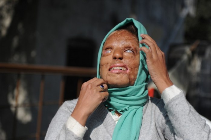 Mujer quemada con ácido se casa con hombre que conoció su historia por TV