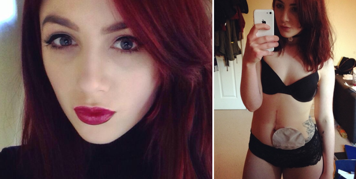 Conoce a la bloguera que no teme posar en bikini con su bolsa de colostomía