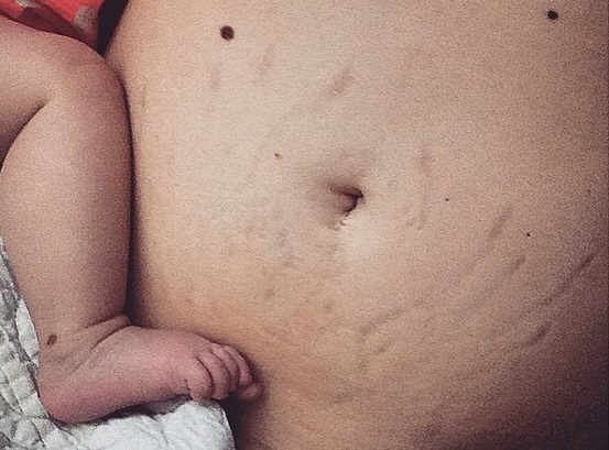 Madres revelan con orgullo cómo luce un cuerpo normal tras el embarazo