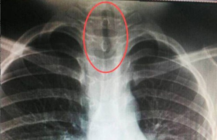 La espeluznante criatura que encontraron en la garganta de un niño chino