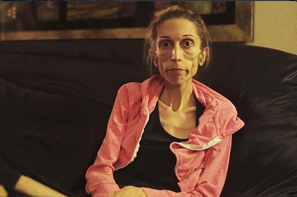 El dramático llamado de mujer con anorexia: pesa 27 kilos y ningún hospital la recibe