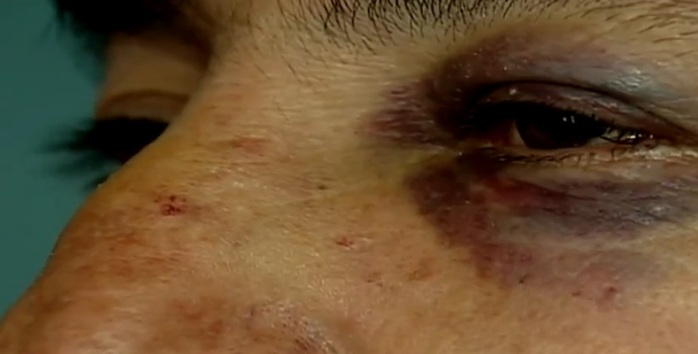 Amigos aseguran haber sido drogados, golpeados y asaltados tras ir a La Piojera