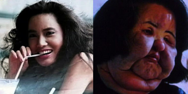 5 famosos casos en que las cirugías plásticas fueron un desastre total