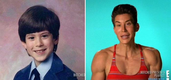 El “Ken Humano” regresó al quirófano: Esta fue su extrema última cirugía