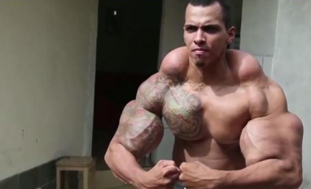Brasileño soñaba con parecerse a Hulk y casi pierde sus brazos
