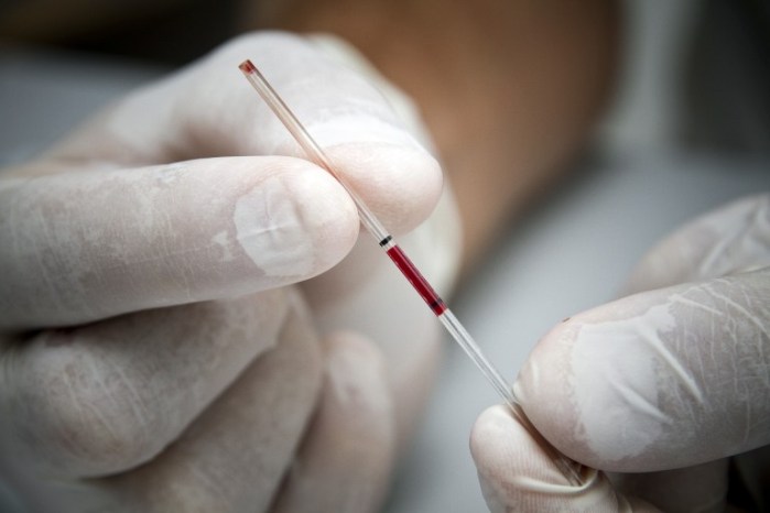 VIH “desaparece” en joven francesa tras 12 años sin medicamentos