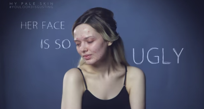 Recibió crudas burlas por su acné: Así de valiente fue su respuesta