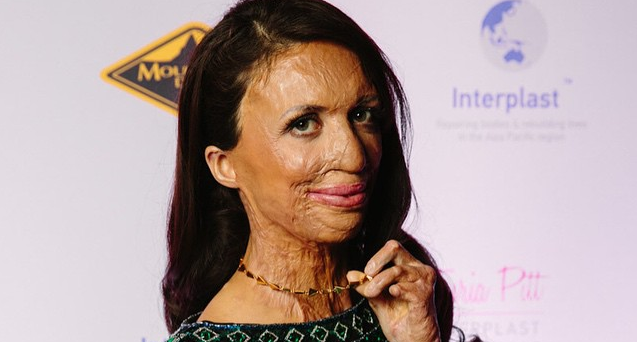 El final feliz de modelo australiana que sobrevivió a feroz incendio