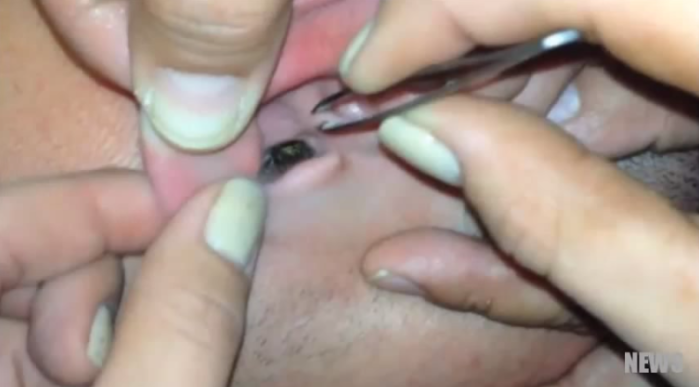 Encuentran asquerosas criaturas en oído de joven chino