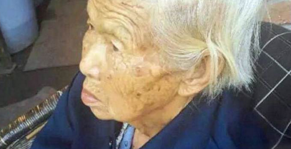 Pensó que era un lunar pero con los años se convirtió en una insólita condición