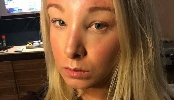 Se aplicó crema facial y su rostro sufrió una horrible reacción