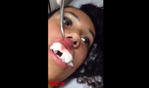 La asquerosa criatura que retiraron del labio de una joven mujer