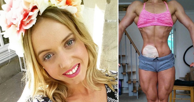 La valiente físicoculturista con una bolsa de colostomía que rompe esquemas