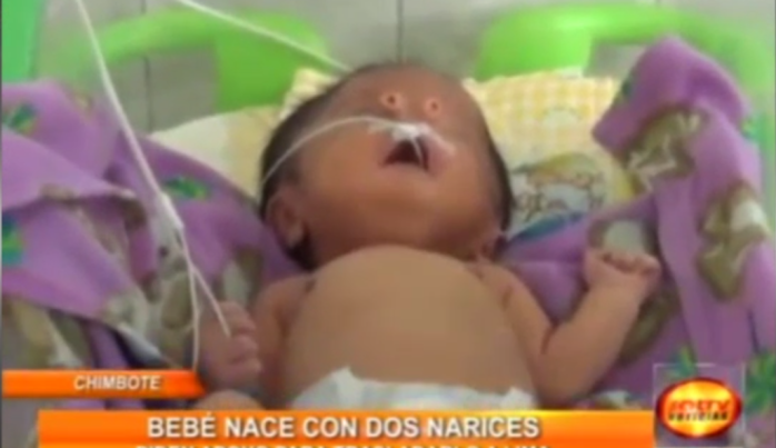 Bebé que nació con dos narices conmueve a Perú: Necesita ayuda