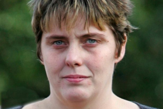 Madre quemada con ácido muestra heridas en su rostro y agradece a quienes la ayudaron