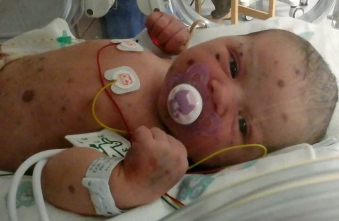 Bebé nació con raro tipo de cáncer y pensaron que moriría: Así se recuperó