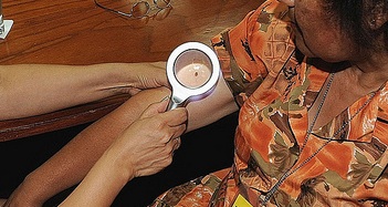 La cantidad de lunares en tu brazo pueden delatar qué tan propenso eres al cáncer de piel