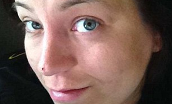 Tuvo cáncer de piel y le rehicieron una nariz: El resultado la dejó al borde del suicidio