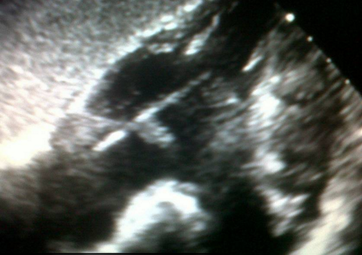 Argentino fue operado del corazón tras constantes infecciones: le encontraron raro objeto