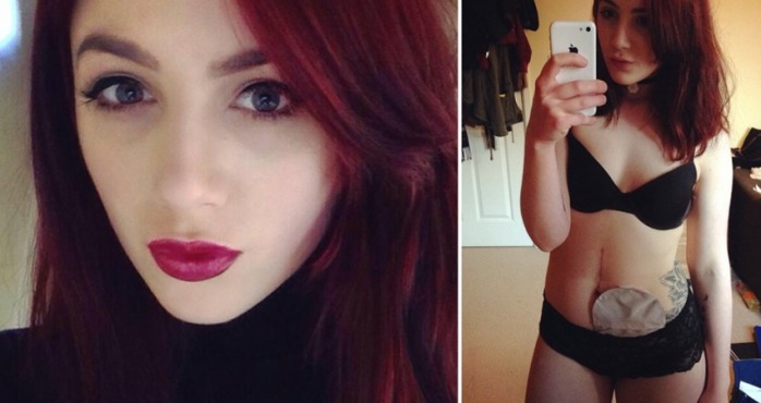 Bloguera dispara contra columnista de MTV que se burló de quienes usan bolsa de colostomía