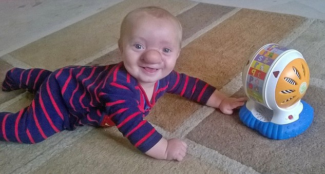 Bebé padece extraña enfermedad: Su cerebro le crece en la nariz