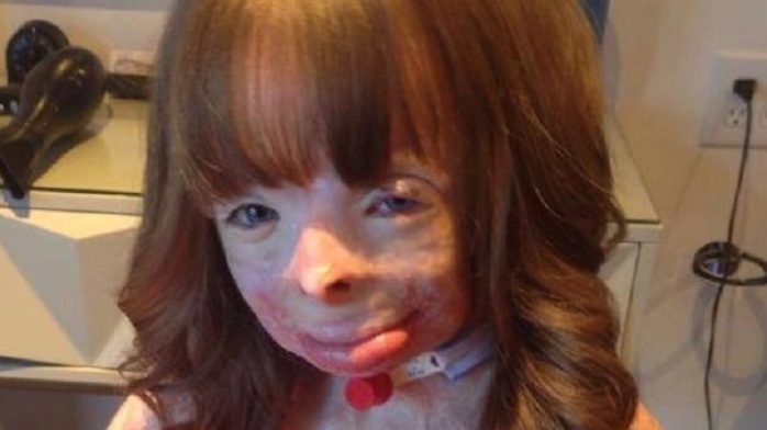 Niña con 75% de su cuerpo quemado ha recibido miles de tarjetas gracias a campaña viral