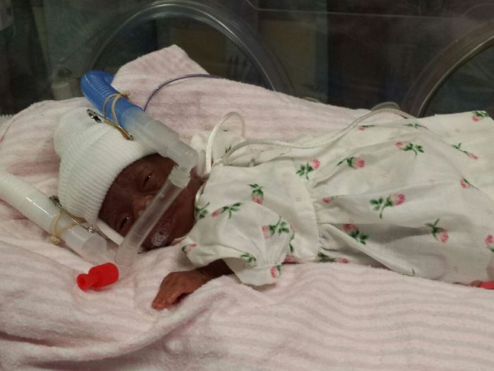 Conoce a la bebé más pequeña del mundo que logra nacer viva: Pesó 0,2 kilos