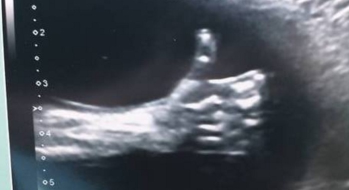 Captura de 'Me Gusta' realizado por feto se viraliza a través de Internet