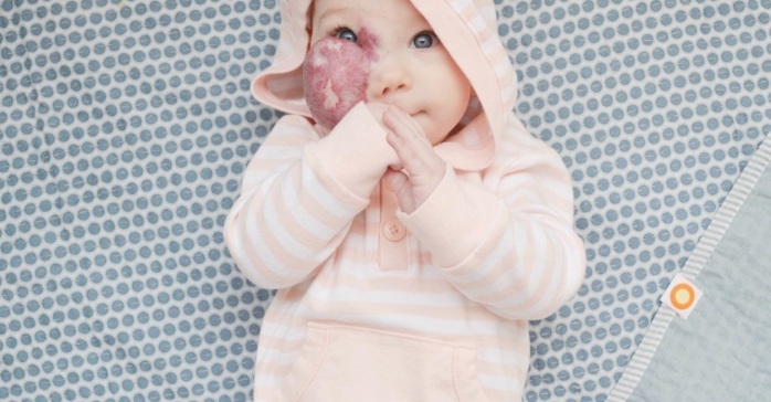 La carta de una mamá a quienes sienten pena por la marca facial de su bebé