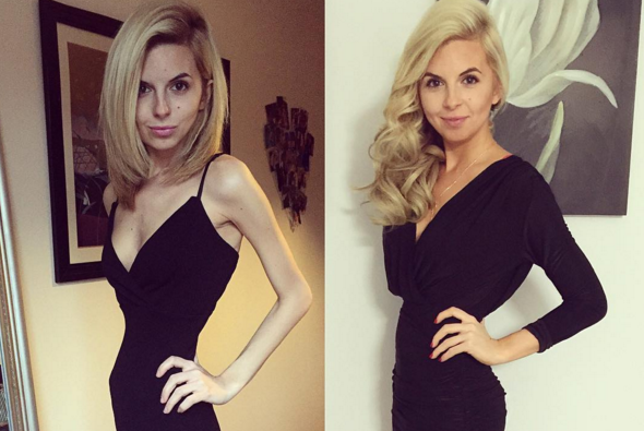 Joven que padecía de anorexia se salvó gracias a Instagram