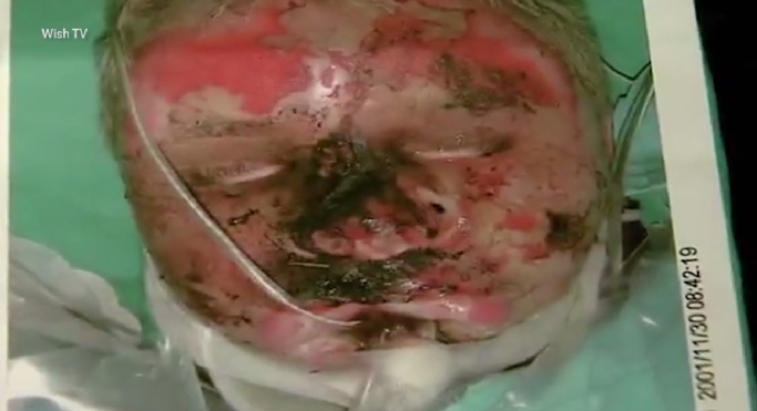 Así quedó el rostro de Mitchell tras las quemaduras producto del accidente | Wish TV