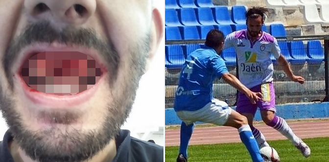 Futbolista recibió brutal golpe que le sacó tres dientes: Así quedó su boca