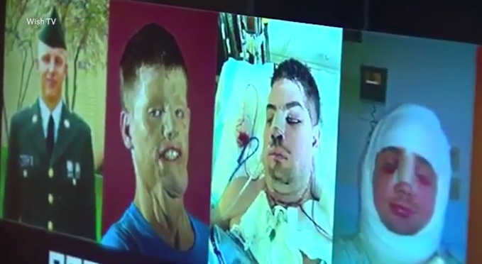 Proceso de recuperación de Mitchell | Wish TV