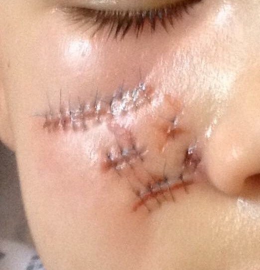 Lesiones en el rostro del niño | Metro.co.uk