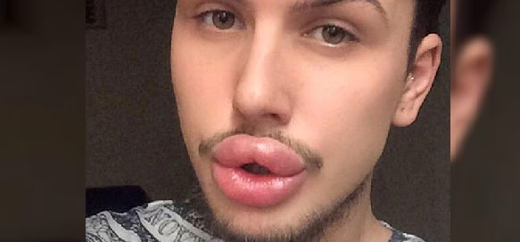 James Holt: el chico que quiere ser una Kardashian y ha gastado $21 millones en cirugías