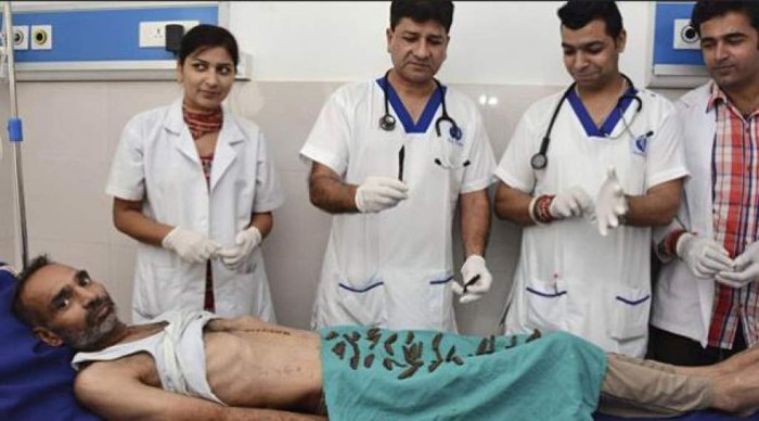 Un hombre fue operado por haberse tragado 40 cuchillos en India