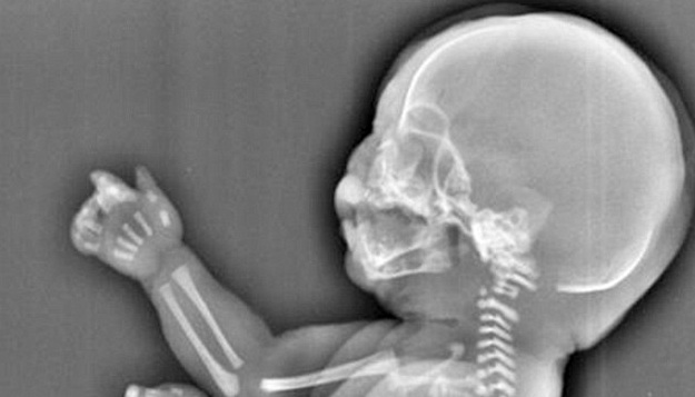 Madre china abortó a su bebé luego de enterarse que tenía 