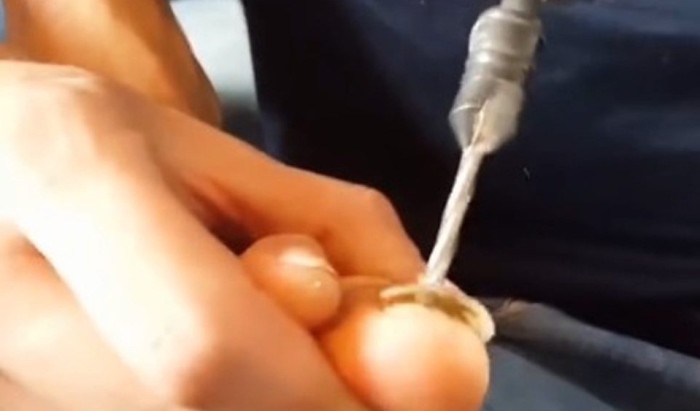 Hombre intentó sacarse adolorida uña haciendo un hoyo con un ¡TALADRO!