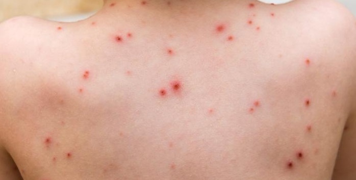 Madre comparte crudas fotos de su bebé con varicela para crear conciencia sobre vacunas