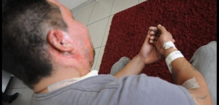 Drama familiar en Coquimbo: Madre de joven quemado por malabarista clama por ayuda