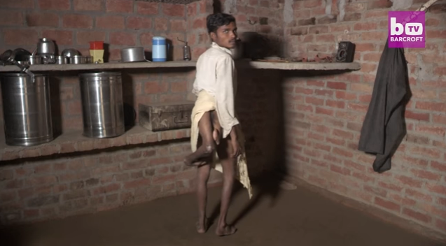 La triste historia de Arun Kumar, el hombre que nació con cuatro piernas