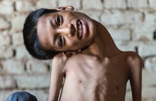 Niño indio con rara condición murió a 8 meses de la operación que cambió su vida