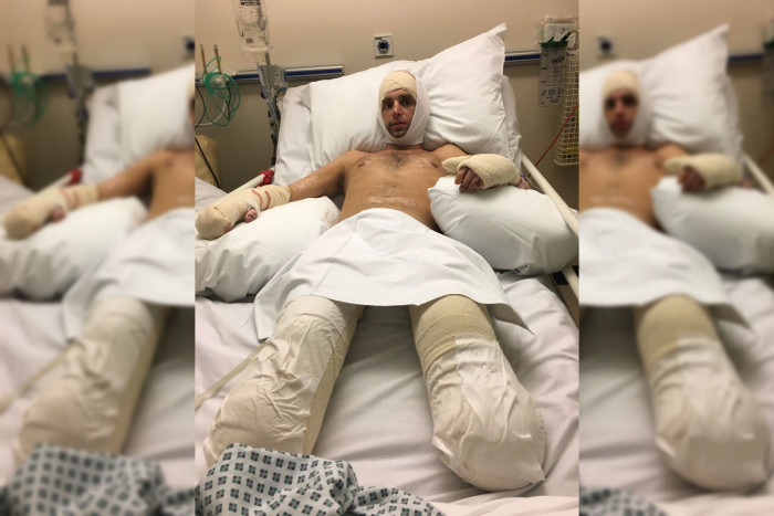 Hombre fue al médico pensando que tenía un resfrío y terminaron amputando sus piernas